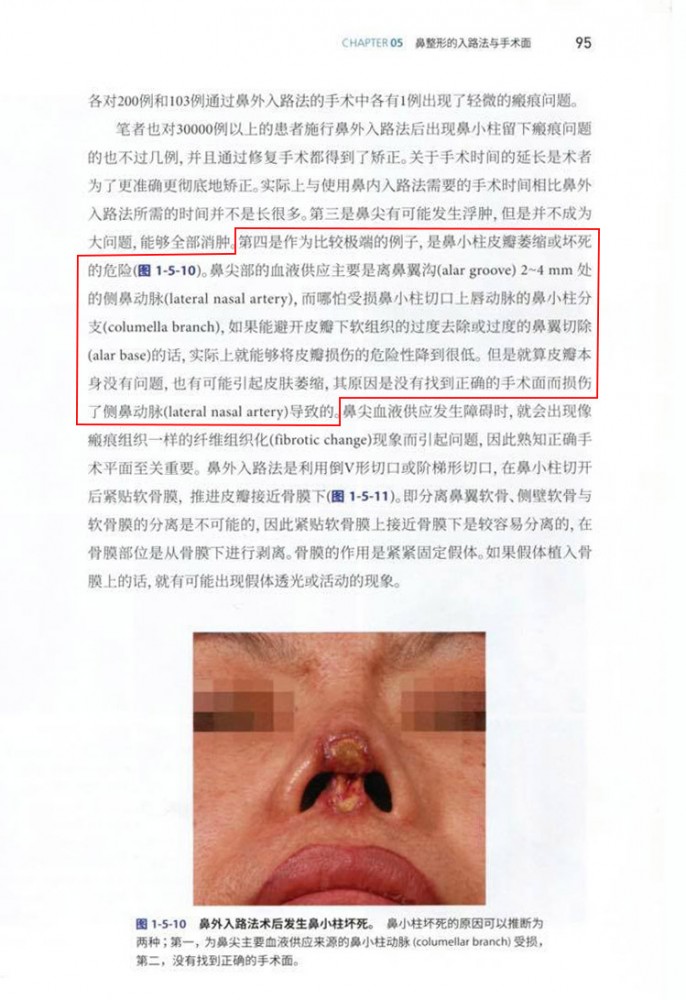 隆鼻失敗造成鼻頭壞死黑掉改善方式,鼻重修,博恩妍