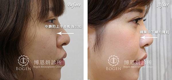 貴族手術案例,鼻溝槽手術案例,貴族手術,博恩妍