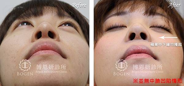 貴族手術案例,鼻溝槽手術案例,貴族手術,博恩妍