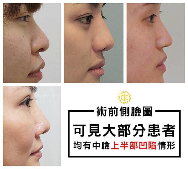 中臉凹陷,貴族手術,博恩妍