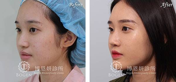 鼻溝槽手術(貴族手術)-博恩妍診所案例分享