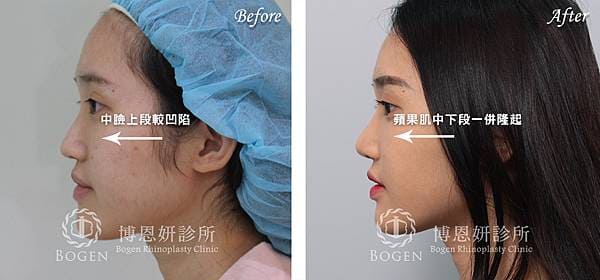 鼻溝槽手術(貴族手術)-博恩妍診所案例分享