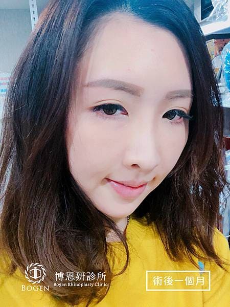 貴族手術案例,鼻溝槽手術案例,貴族手術,博恩妍