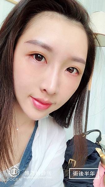 貴族手術案例,鼻溝槽手術案例,貴族手術,博恩妍