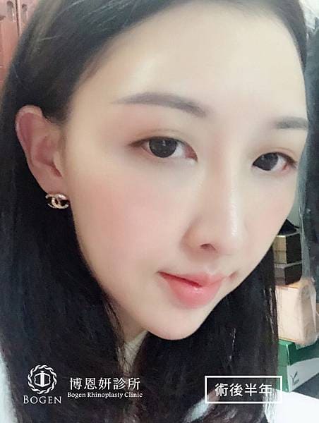 貴族手術案例,鼻溝槽手術案例,貴族手術,博恩妍