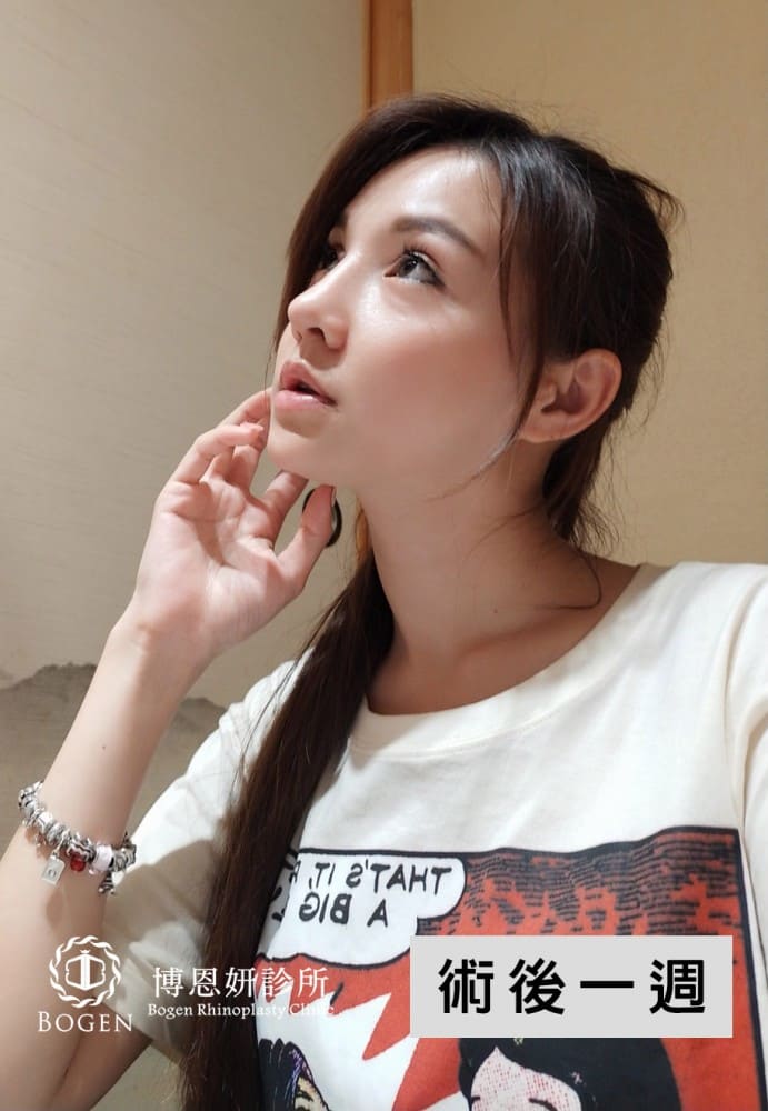 隆鼻假體邊緣感術後1周案例,博恩妍