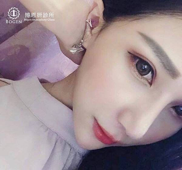 網紅鼻,隆鼻分鼻樑手術與鼻頭手術,隆鼻,博恩妍