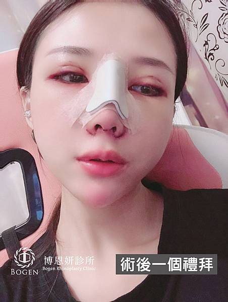 隆鼻術後一周,隆鼻術後,金屬鼻板,博恩妍