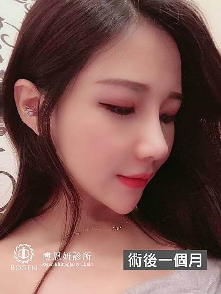 網紅鼻隆鼻術後1個月,貴族手術術後1個月,隆鼻,貴族手術,博恩妍