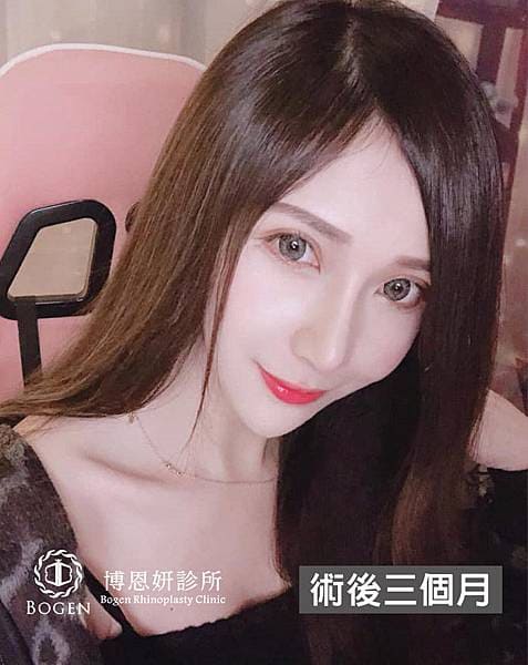 網紅鼻隆鼻術後3個月,貴族手術術後3個月,隆鼻,貴族手術,博恩妍