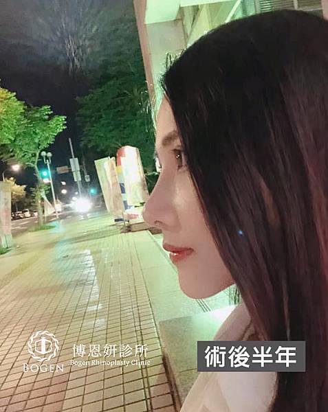 網紅鼻隆鼻術後6個月,貴族手術術後6個月,隆鼻,貴族手術,博恩妍