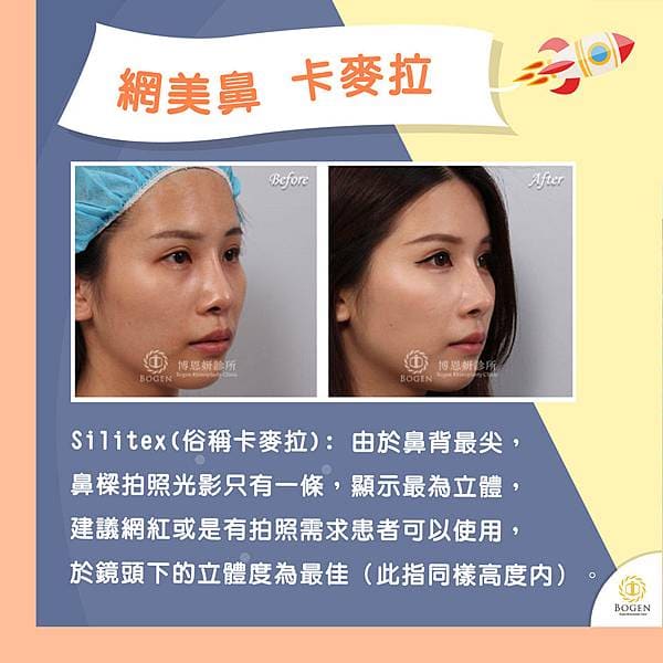 網紅鼻,網美鼻,卡麥拉隆鼻,隆鼻,博恩妍