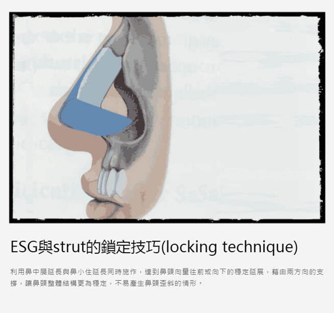 鼻頭軟骨固定術,無假體隆鼻,自體肋軟骨隆鼻,無假體,隆鼻,博恩妍