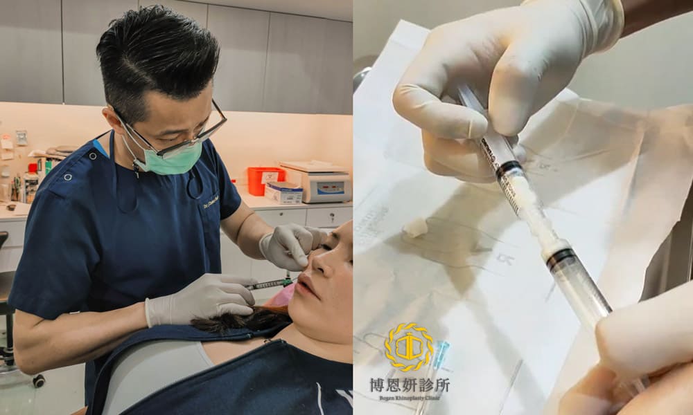 博恩妍診所張簡醫師針對法令紋施打異體真皮粉