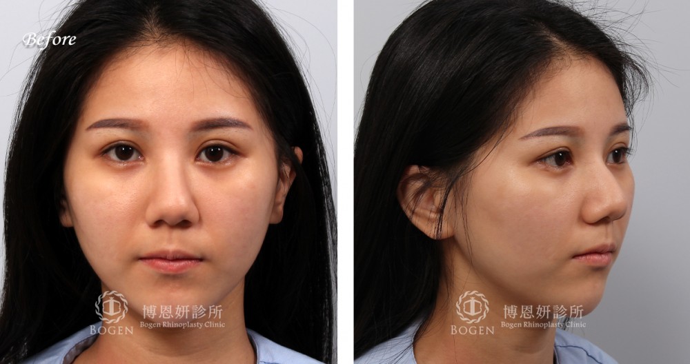 縮鼻頭與歪鼻矯正案例,縮鼻頭,歪鼻矯正,博恩妍