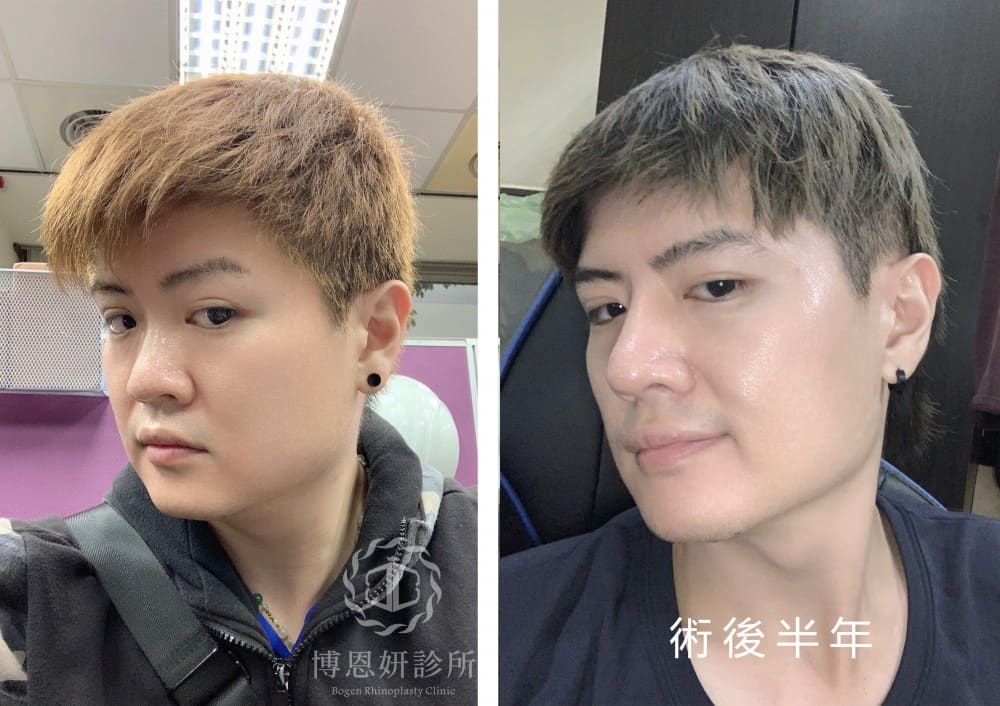 男性隆鼻,男性鼻整形,隆鼻手術,博恩妍