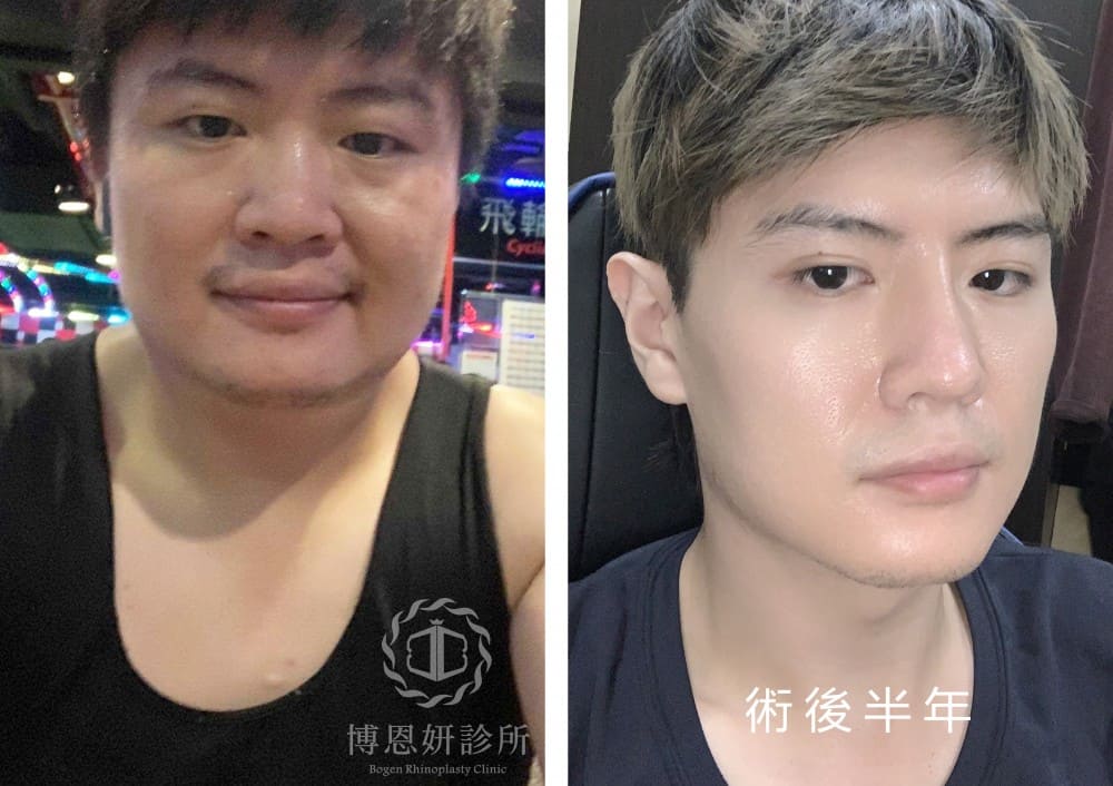 男性隆鼻,男性鼻整形,隆鼻手術,博恩妍