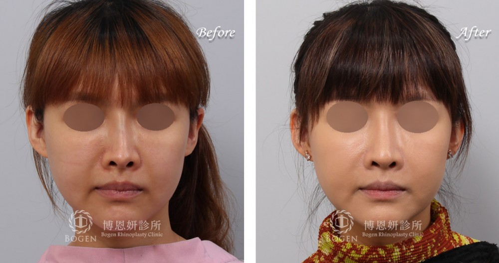 博恩妍整所張簡醫師假體感過重鼻型鼻重修案例