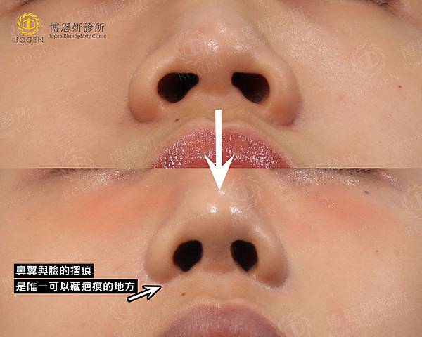 鼻翼手術的疤痕多藏於摺痕裡,博恩妍