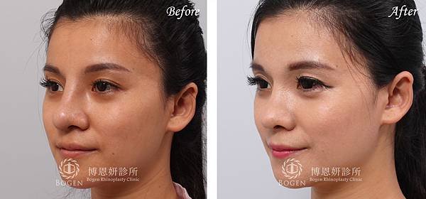 博恩妍診所張簡醫師感染鼻鼻重修全自體肋軟骨隆鼻案例