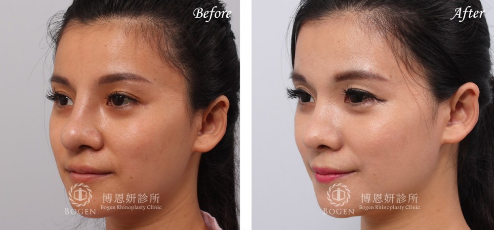 博恩妍診所鼻重修鼻整形案例