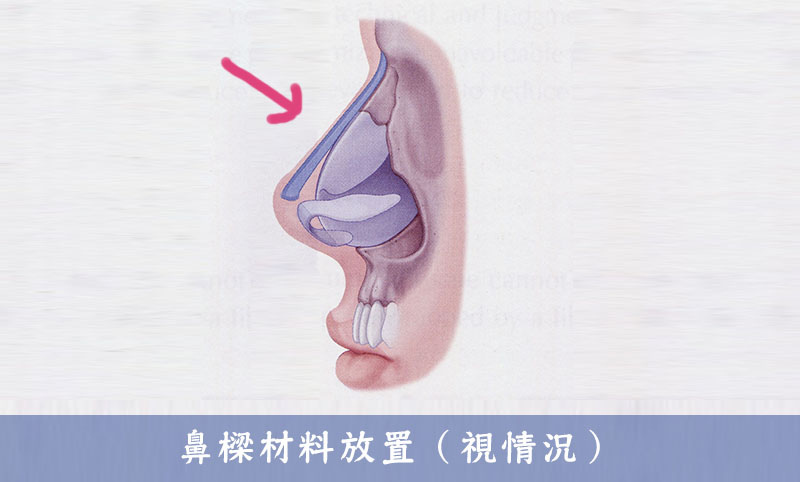 歪鼻調整-鼻樑材料放置示意圖