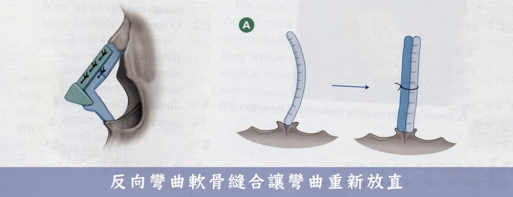 歪鼻調整-反向彎曲軟骨縫合示意圖