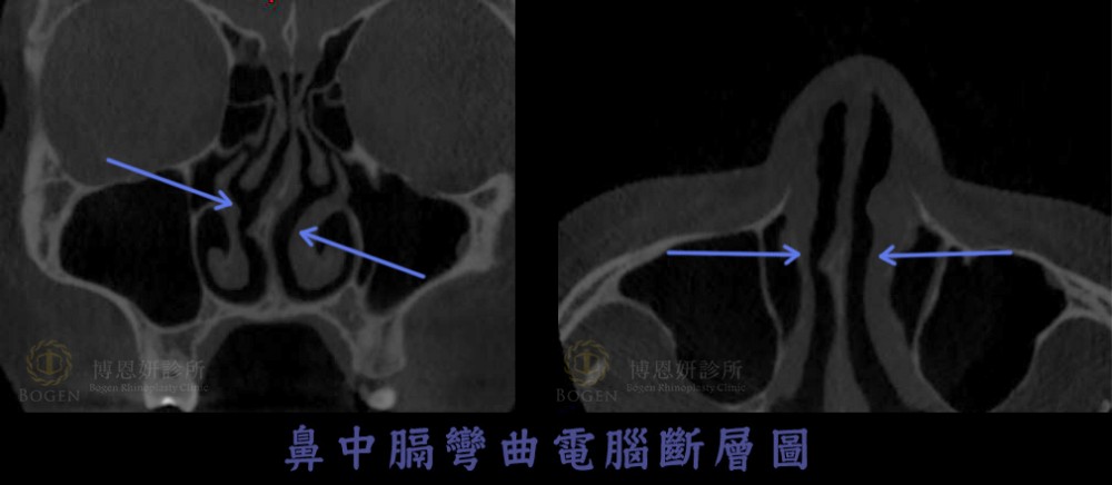 歪鼻調整-鼻中膈彎曲電腦斷層