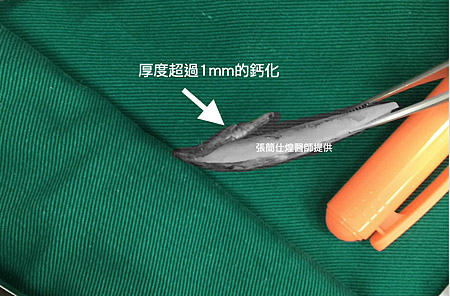 厚度超過1mm的假體鈣化,嚴重鈣化矽膠假體,鼻重修案例,博恩妍