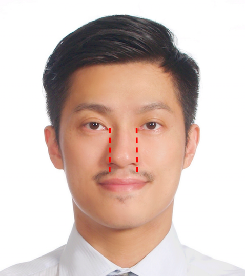 博恩妍診所張簡醫師親自展示鼻翼寬大的鼻部型態