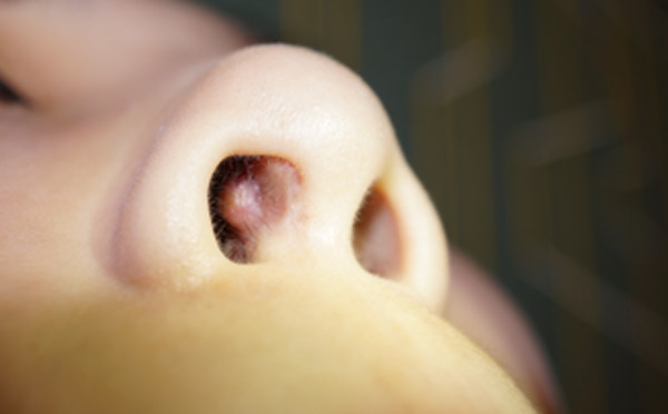 鼻黏膜假體穿出,鼻黏膜內人工骨穿出