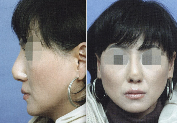 鼻頭出現局部凹陷的第一型攣縮鼻案例