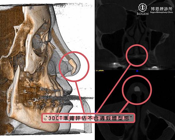 電腦斷層掃描鼻部狀況及假體位置,博恩妍診所