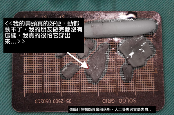 隆鼻假體取出,隆鼻鼻頭硬,人工骨,博恩妍