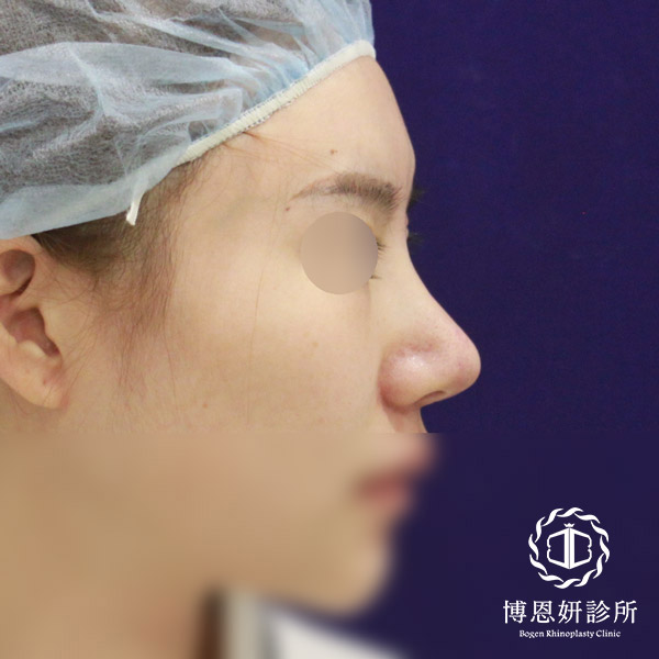 人工骨過硬導致的木偶鼻案例,隆鼻鼻頭硬,博恩妍