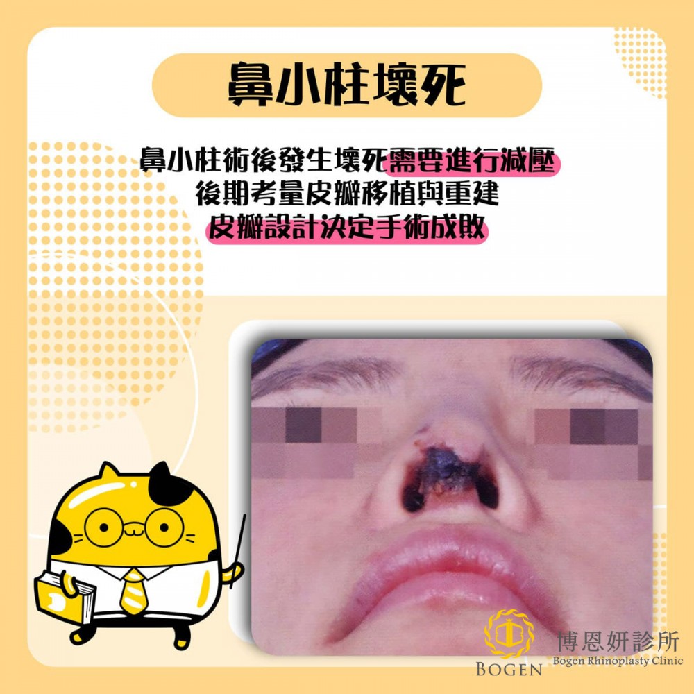 鼻小柱壞死修復鼻重修手術,鼻小柱壞死,鼻小柱,博恩妍