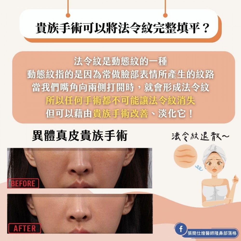 貴族手術可以將法令紋完整填平,博恩妍