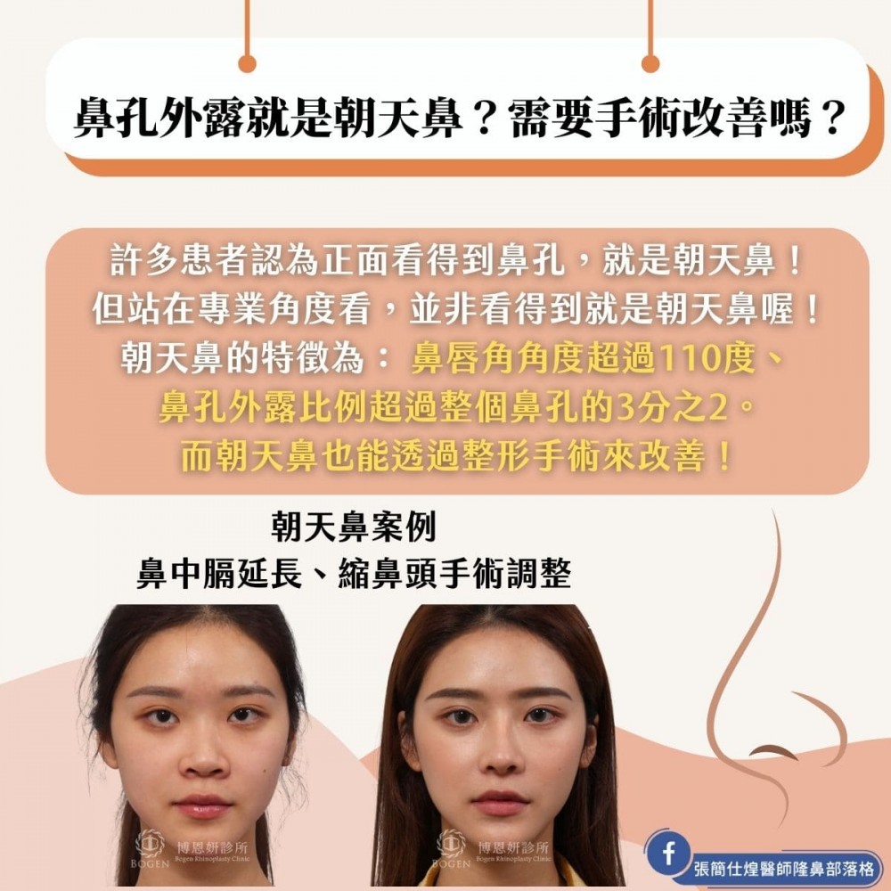 朝天鼻手術改善朝天鼻,博恩妍