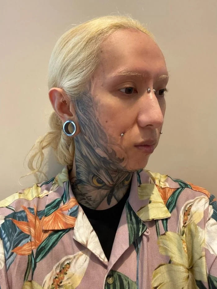 異體真皮法令紋,法令紋貴族手術,異體真皮,法令紋手術,博恩妍