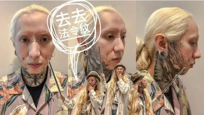 異體真皮法令紋,法令紋貴族手術,異體真皮,法令紋手術,博恩妍