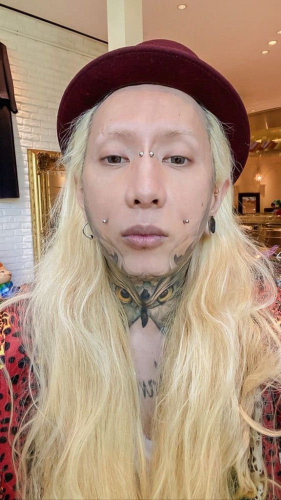 異體真皮法令紋,法令紋貴族手術,異體真皮,法令紋手術,博恩妍