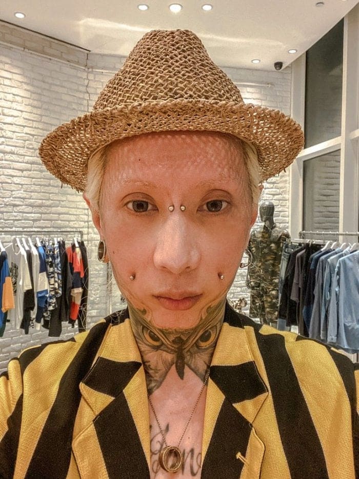 異體真皮法令紋,法令紋貴族手術,異體真皮,法令紋手術,博恩妍