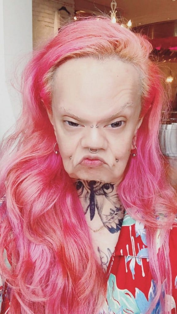 異體真皮法令紋,法令紋貴族手術,異體真皮,法令紋手術,博恩妍
