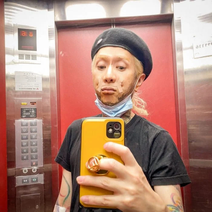 異體真皮法令紋,法令紋貴族手術,異體真皮,法令紋手術,博恩妍