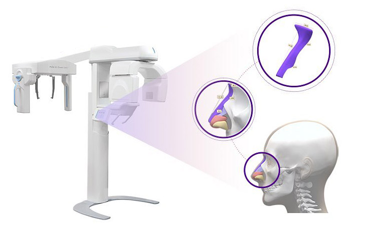 電腦斷層掃描,完形美3D列印客製化鼻模