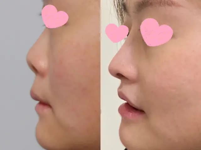 朝天鼻露鼻孔改善,張簡醫師