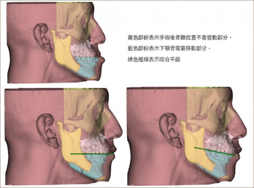 正顎手術,上下顎複合體順時針旋轉,許修銨醫師,博恩妍