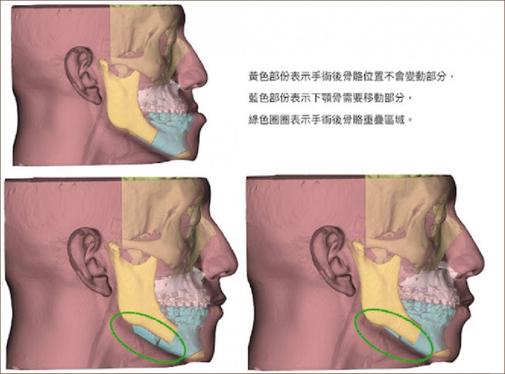 正顎手術,上下顎複合體順時針旋轉,許修銨醫師,博恩妍