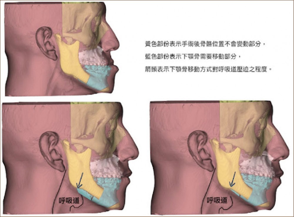 正顎手術,上下顎複合體順時針旋轉,許修銨醫師,博恩妍