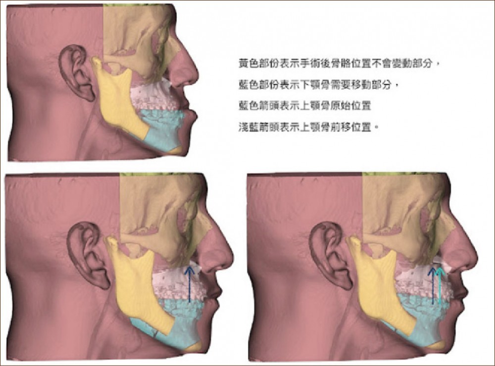 正顎手術,上下顎複合體順時針旋轉,許修銨醫師,博恩妍